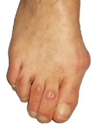 hallux preoperatoire